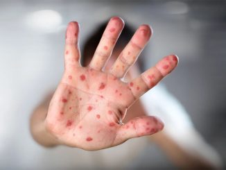 Обезьянья оспа на Тенерифе - на острове уже два подтверждённых случая