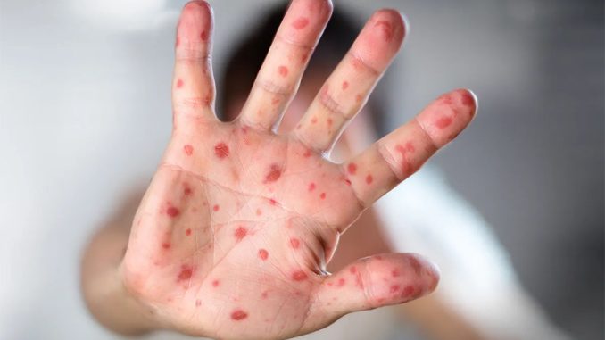 Обезьянья оспа на Тенерифе - на острове уже два подтверждённых случая Обезьянья оспа на Тенерифе - на острове уже два подтверждённых случая