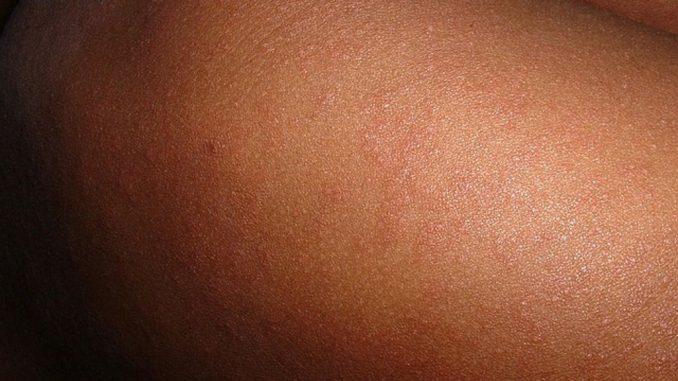 Внимание: подтверждена вспышка кори на острове Тенерифе